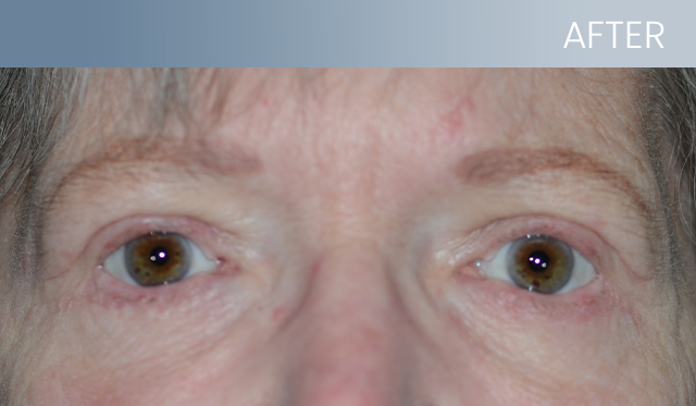 Before & After - OcalaEye Eyelids