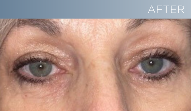 Can Under Eye Bags be Removed Without Surgery? - Ocala Eye